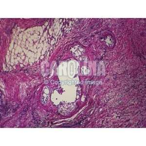  Human Adenocarcinoma of Lung, sec. Microscope Slide, 7 u 