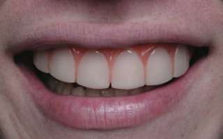 ultra thin veneer form fits in 5 minutes to the front of your teeth so 