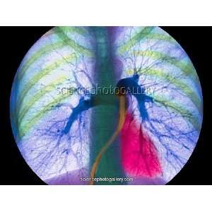  Coloured angiogram showing the pulmonary arteries 