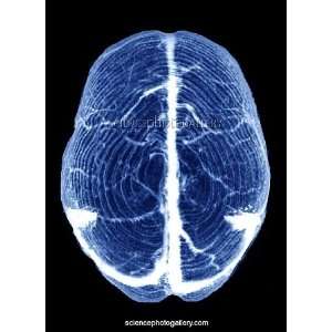 Venous sinuses in brain, CT scan Framed Prints 